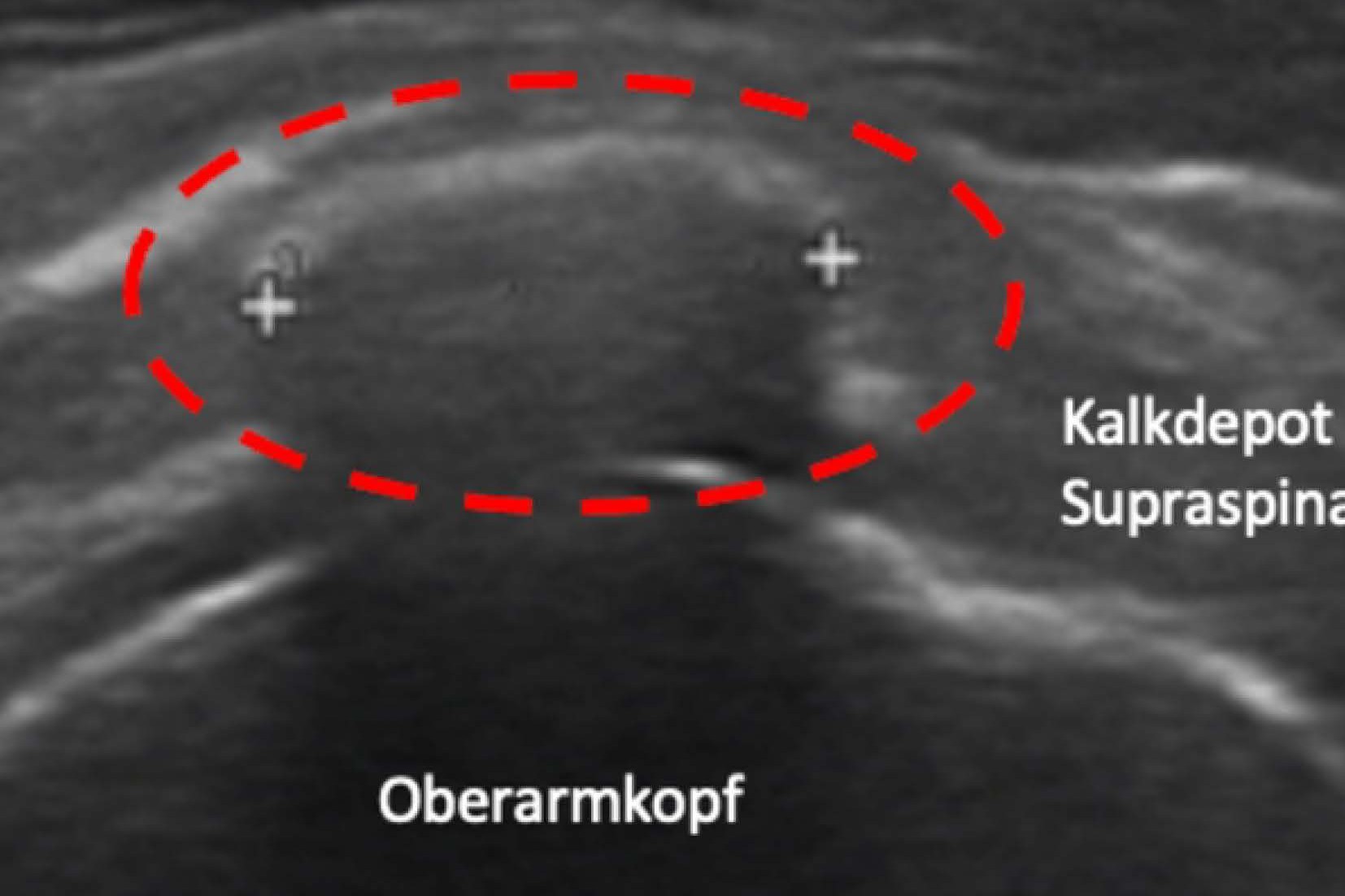 Schultertherapie 02